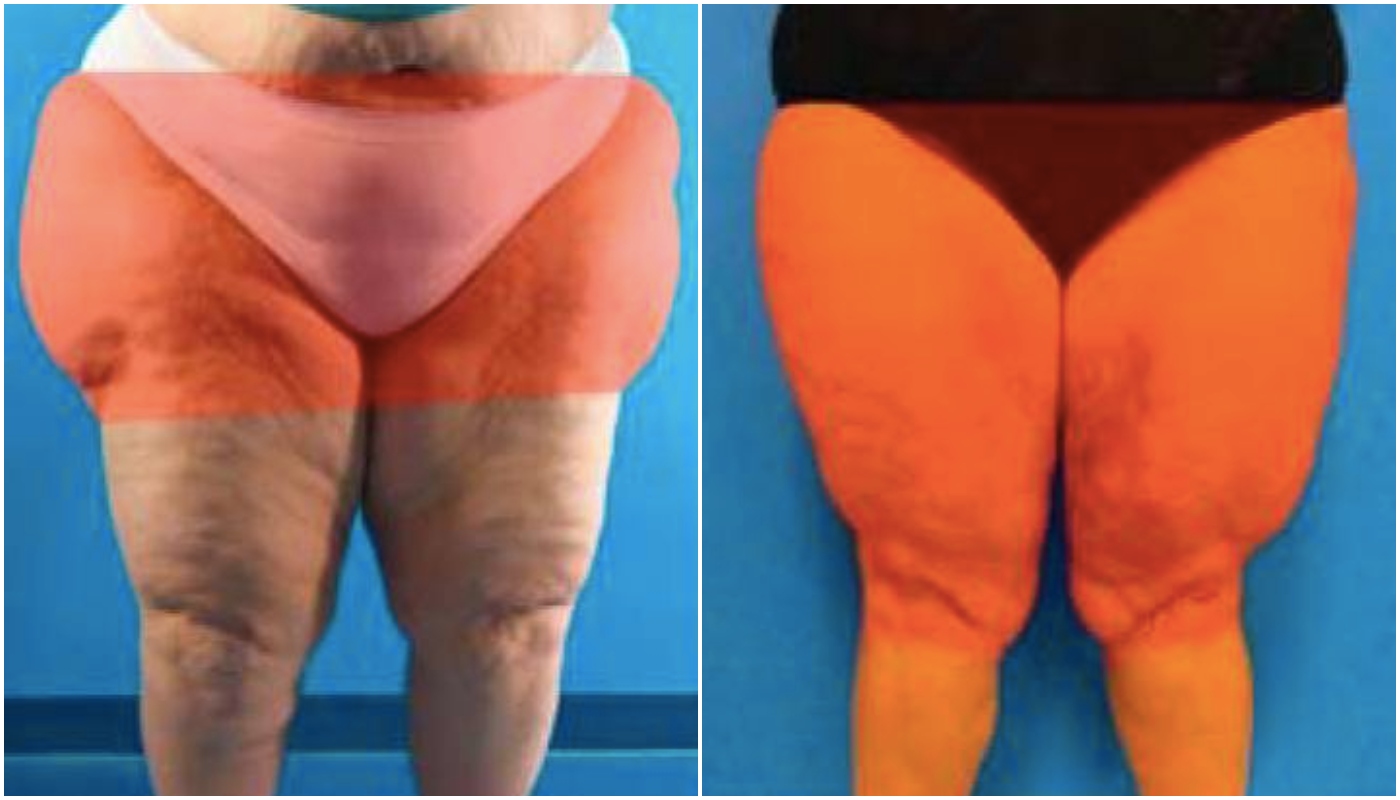 Como saber se tenho lipedema? Conheça as características dessa doença tão confundida com obesidade