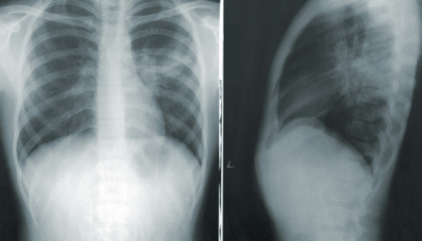 sintomas de pneumonia