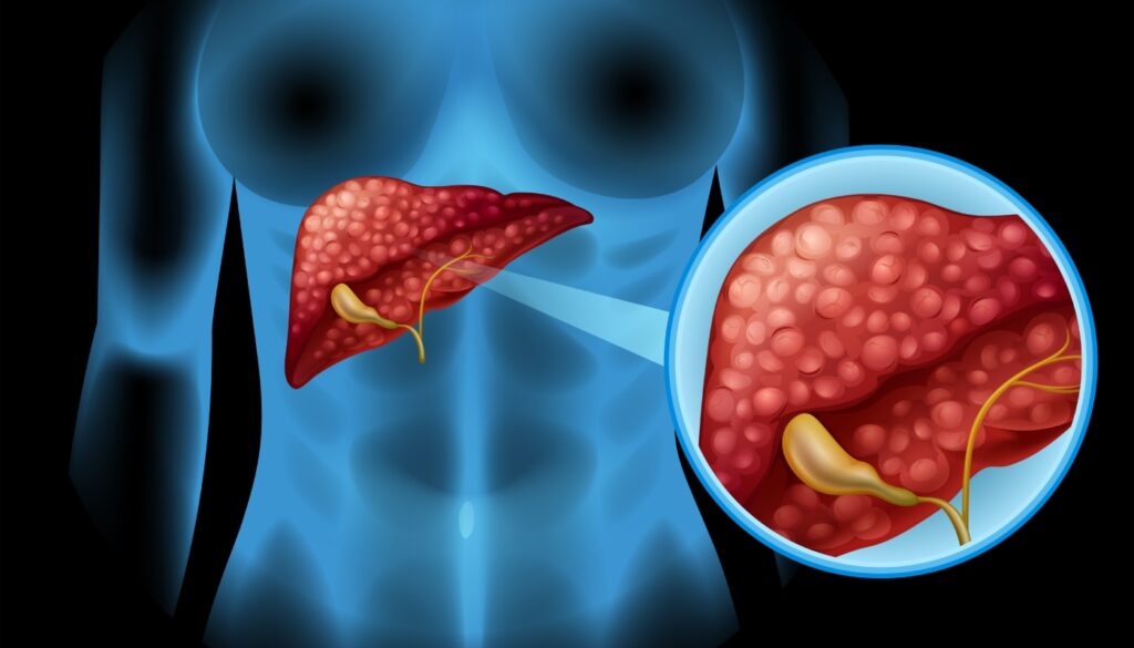 hepatite autoimune