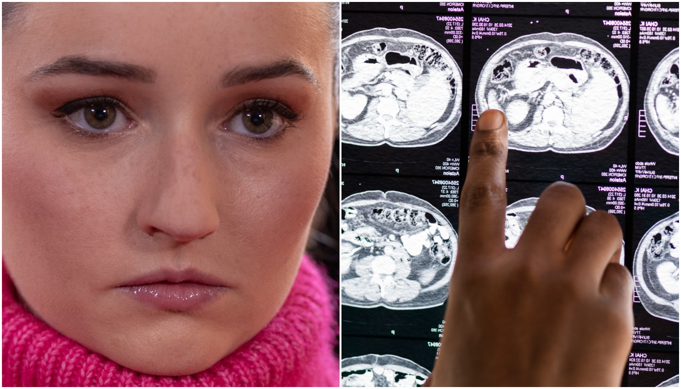Câncer no cérebro tem cura? Saiba tudo sobre tumores cerebrais e avanços no tratamento