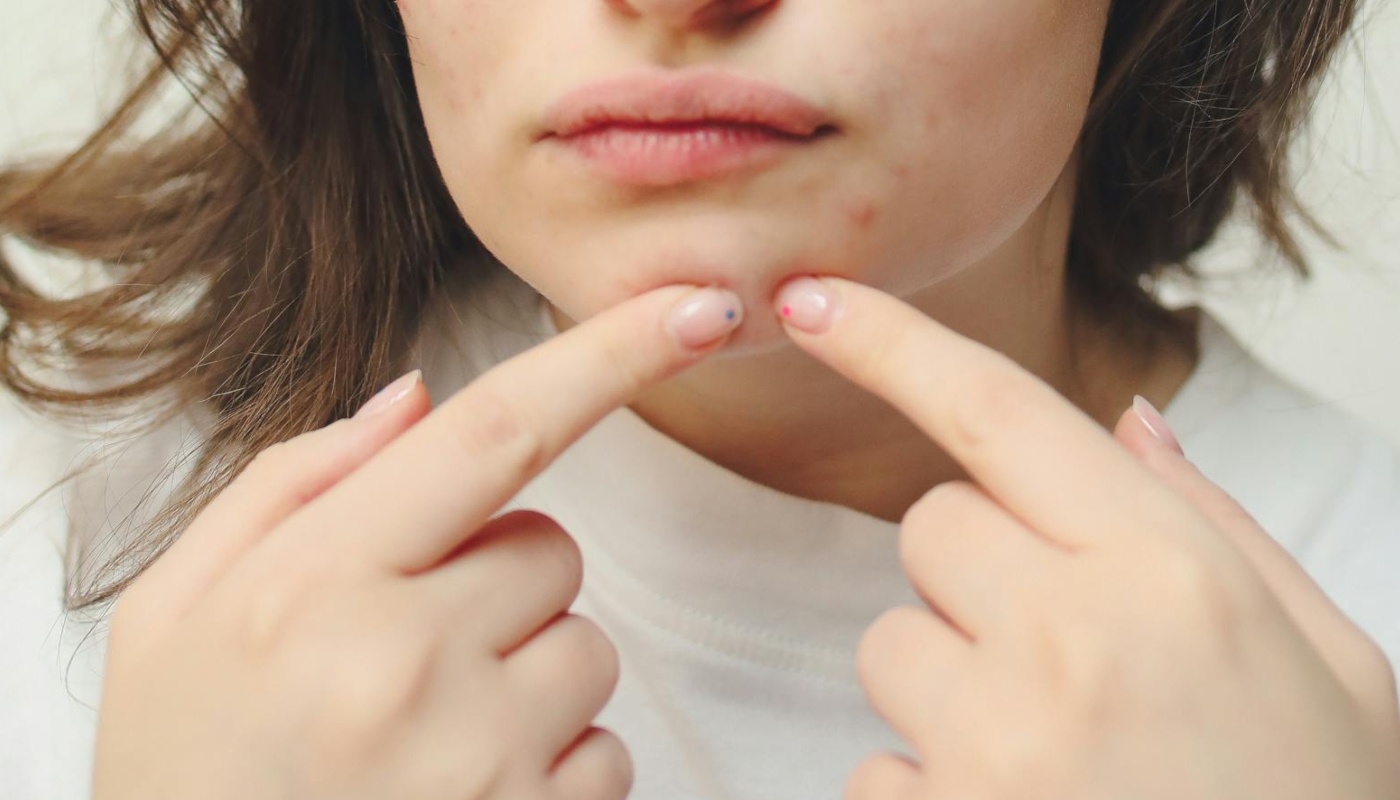 Espremer espinha pode matar? Médica explica possíveis riscos graves desse hábito