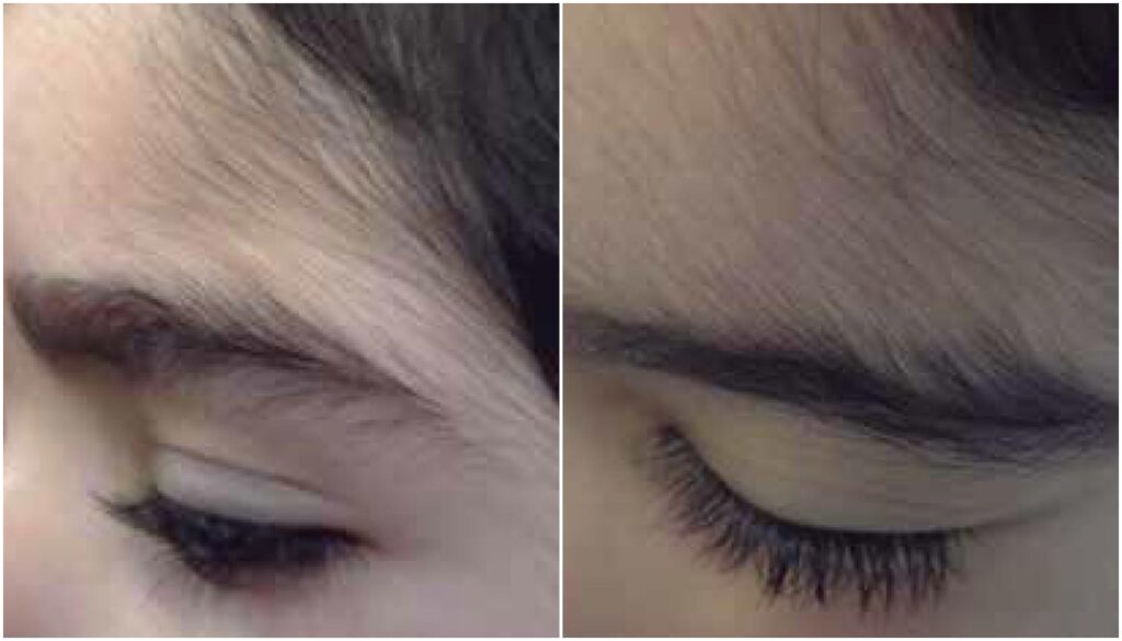 Exemplo de criança com hipertricose por contato com Minoxidil, mas não relacionado aos casos mencionados pela Anvisa (Crédito: Reprodução/Anais Brasileiros de Dermatologia)