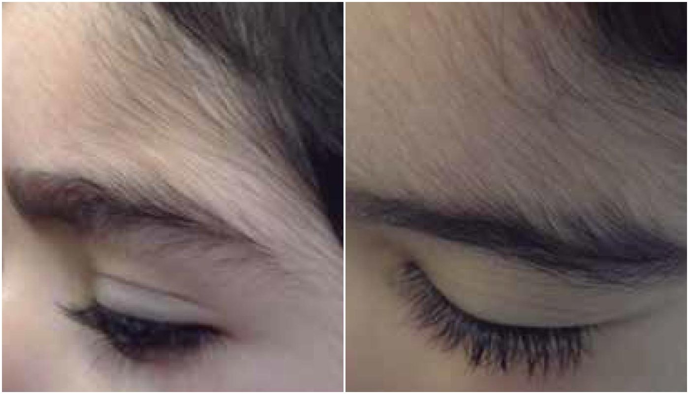 Exemplo de criança com hipertricose por contato com Minoxidil, mas não relacionado aos casos mencionados pela Anvisa (Crédito: Reprodução/Anais Brasileiros de Dermatologia)