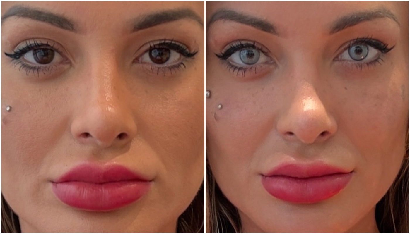 Procedimento para mudar a cor dos olhos é seguro? Entenda como é feito e quais os riscos