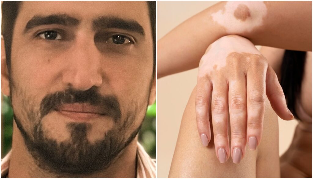 renato góes vitiligo