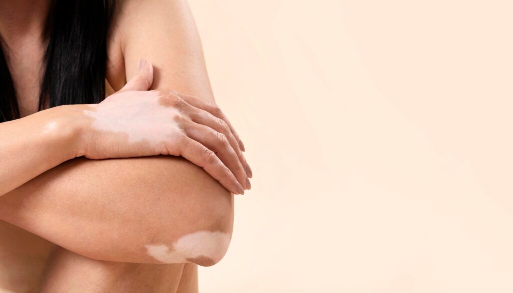 vitiligo