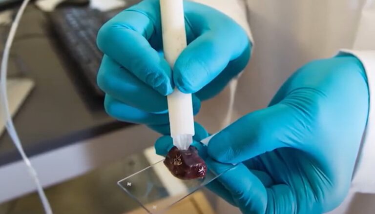 caneta que detecta câncer