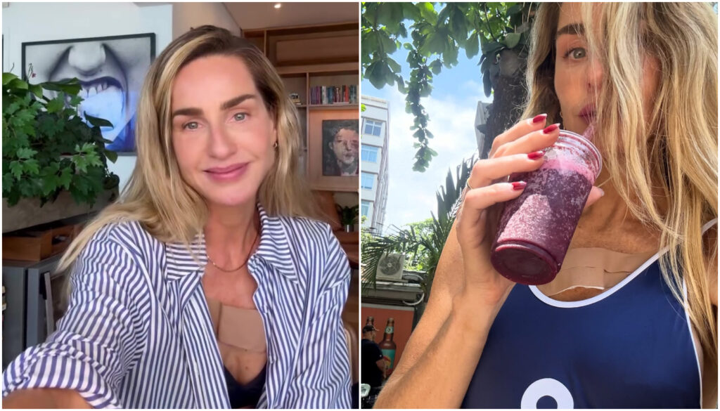 A modelo Mariana Weickert usou o Instagram para contar que descobriu um carcinoma basocelular, tipo comum de câncer de pele.