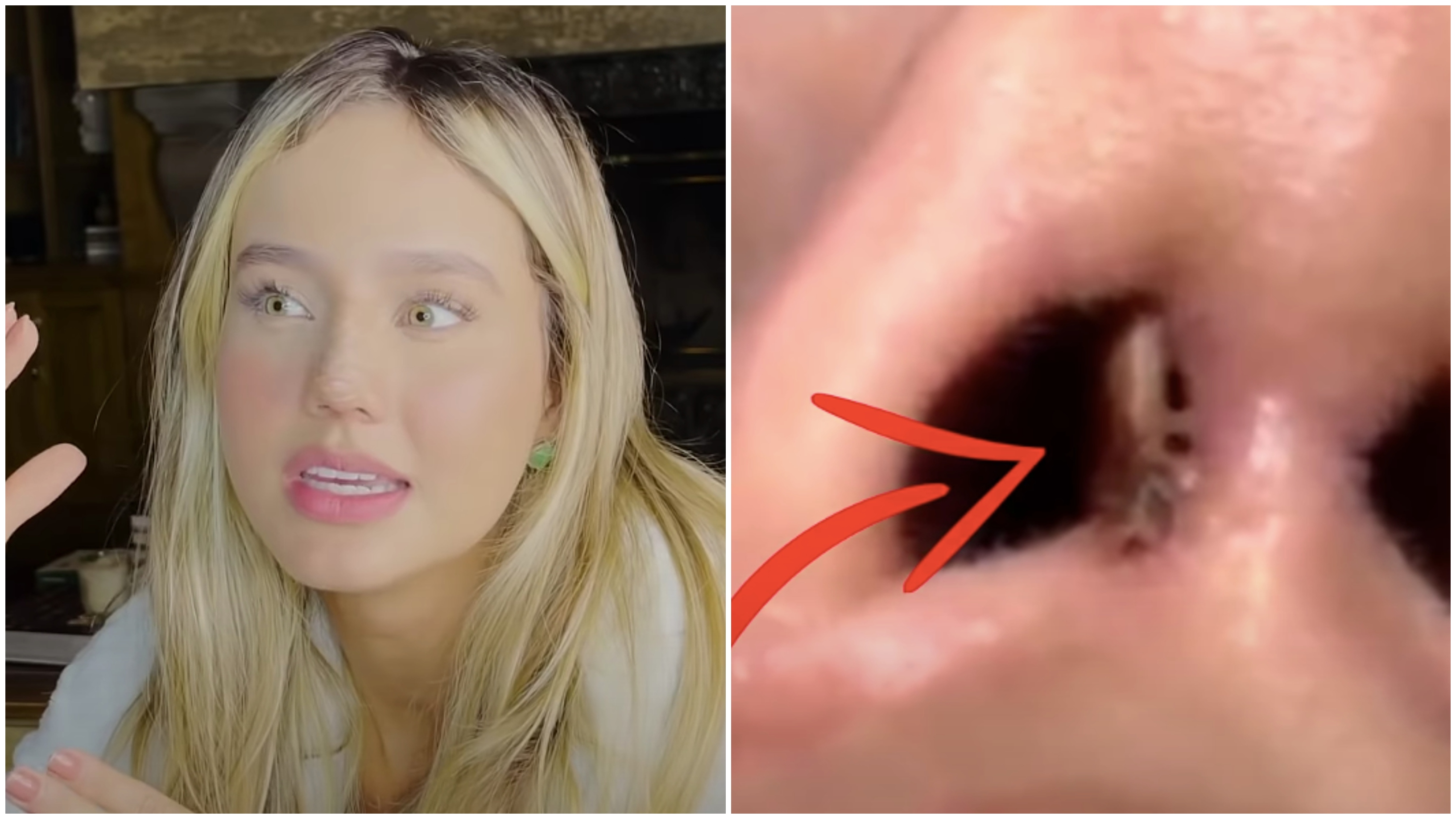 Biah Rodrigues teve complicações após realizar uma rinoplastia