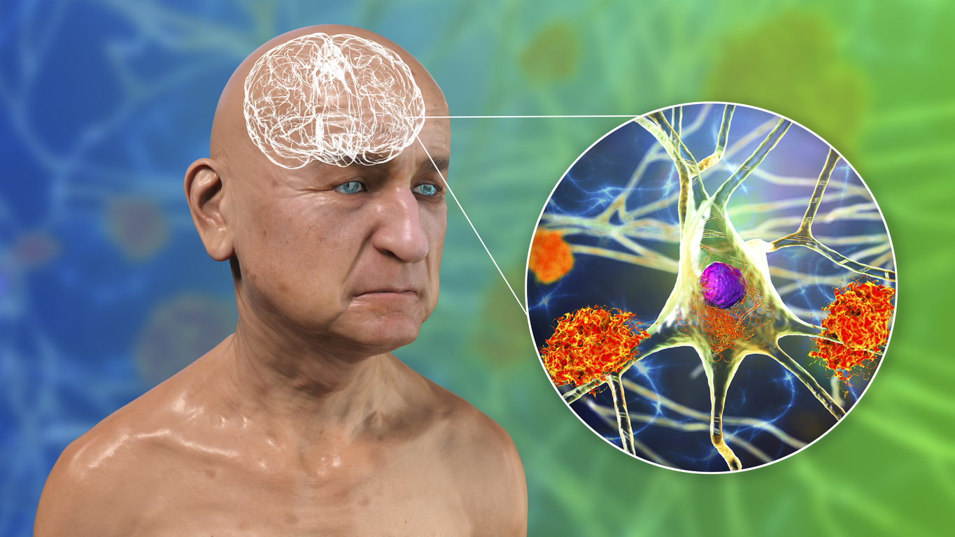 Demência frontotemporal afeta a comunicação e o comportamento de quem sofre da doença