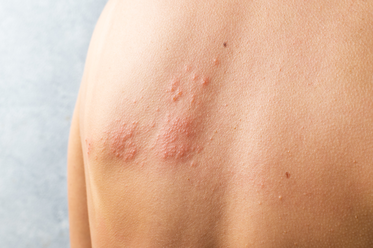 Herpes-zóster