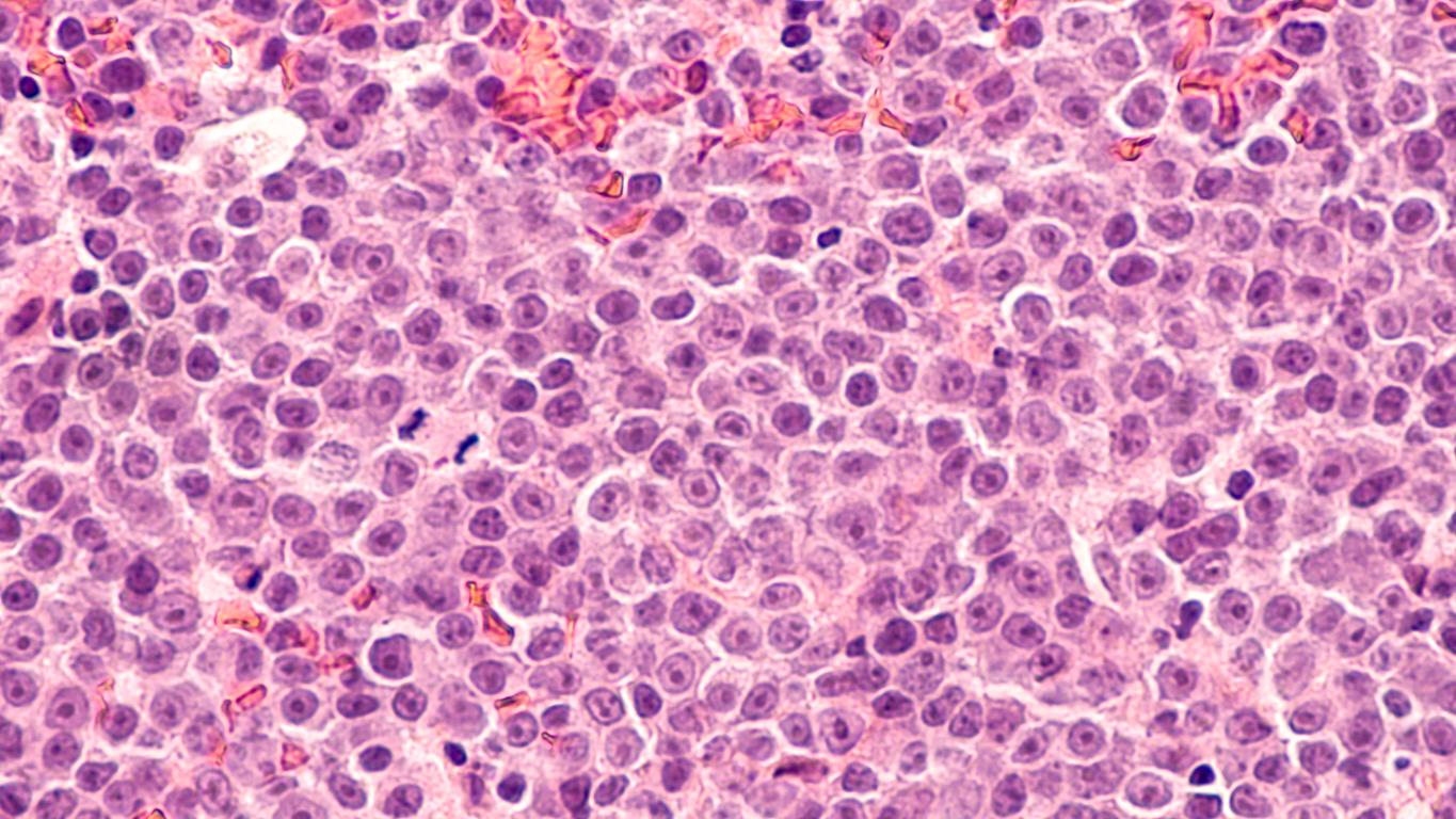 O linfoma que ocorre em decorrência do silicone começa com o chamado seroma