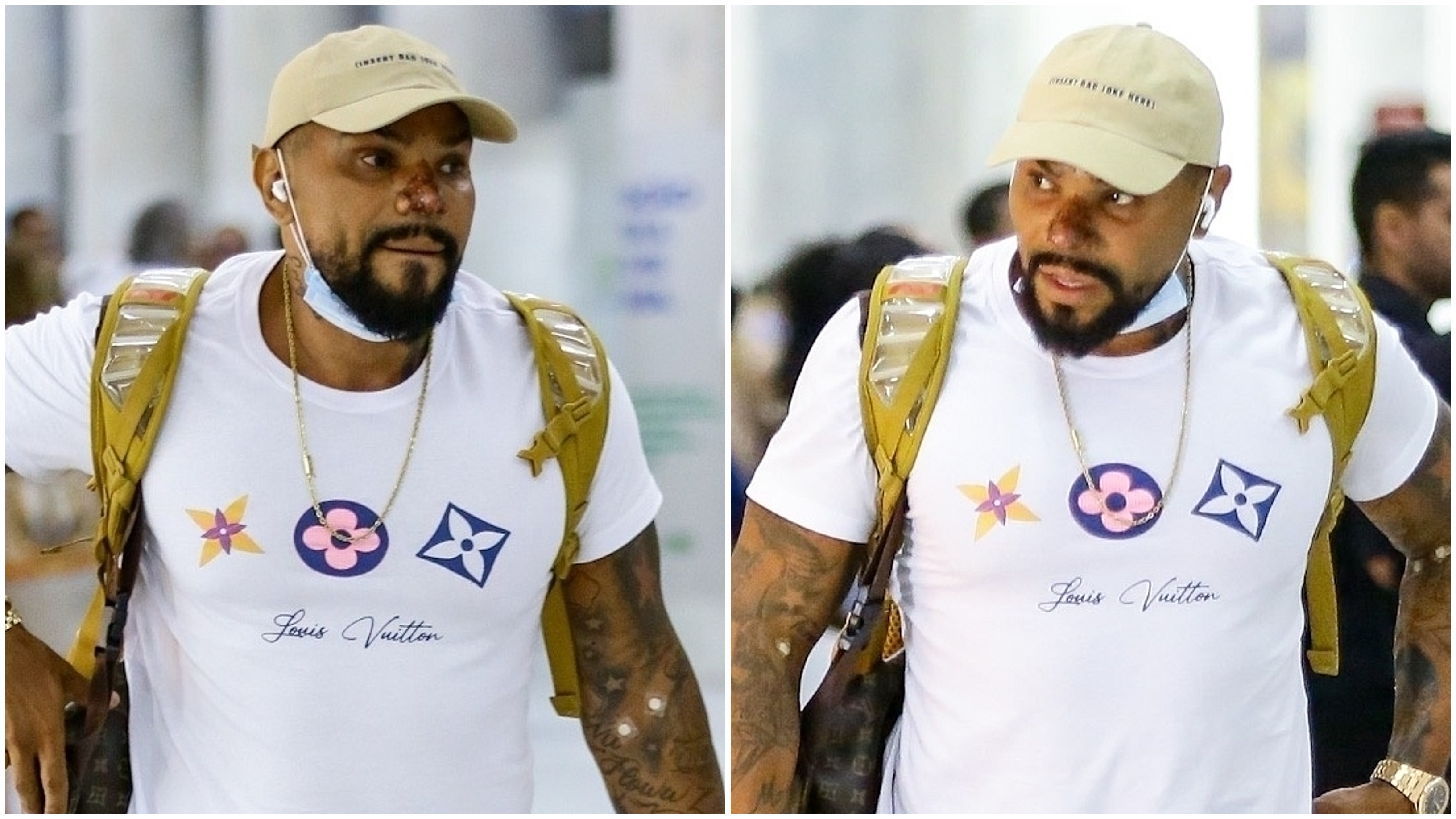 Naldo Benny está sofrendo com complicações de uma rinomodelação