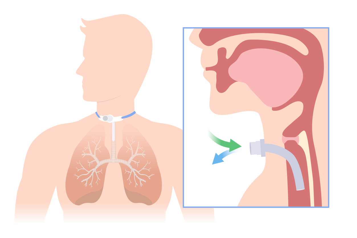 Traqueostomia é um procedimento que permite a passagem de ar quando há dificuldade respiratória