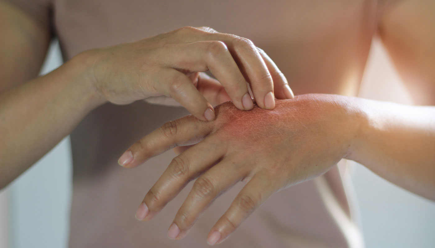 Sabia que algumas pessoas têm alergia à carne? Sintomas na pele e respiração surgem após 3 horas