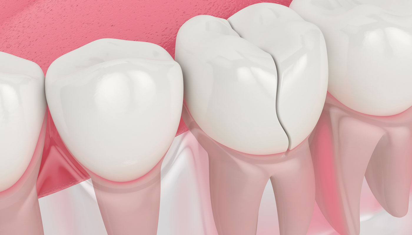 Rachadura no dente