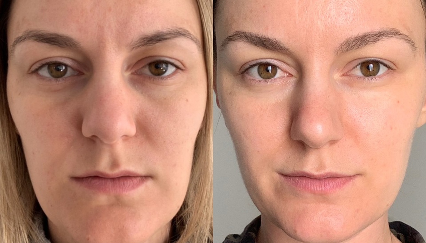 “Doença do silicone” alterou rosto de mulher e agora ela faz alerta: entenda o problema