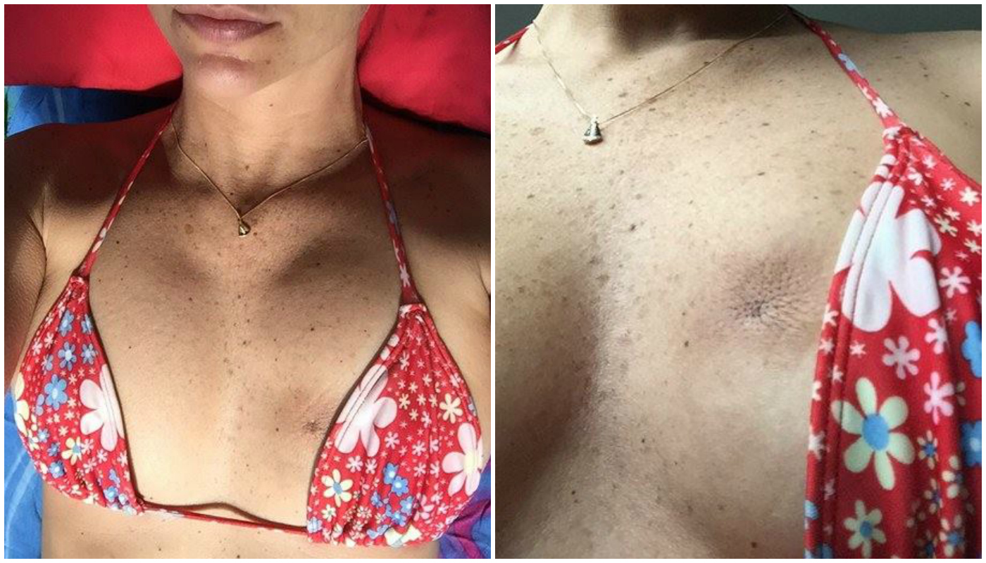 Após mudança incomum na mama, modelo descobre câncer já em estágio avançado