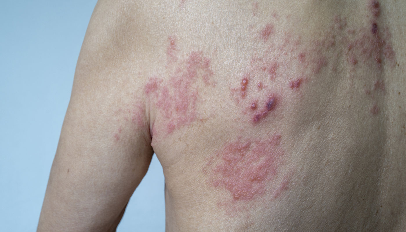 Herpes-zóster