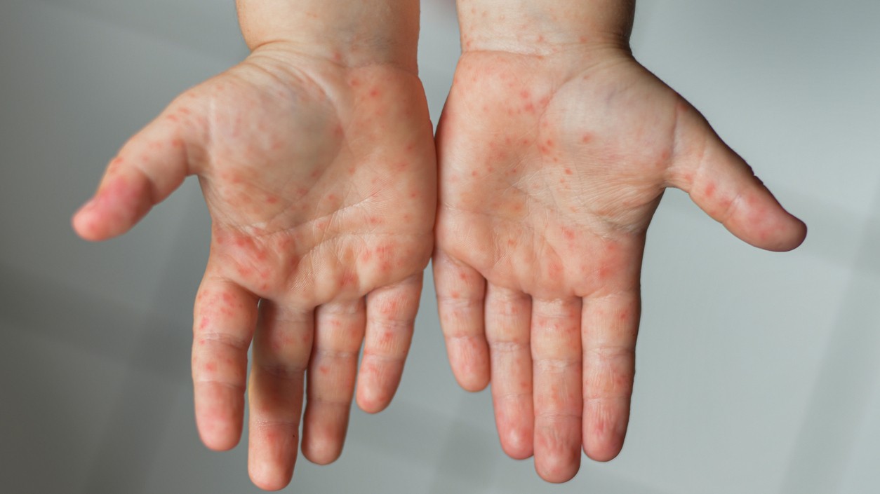 Gripe do tomate gera erupções cutâneas avermelhadas