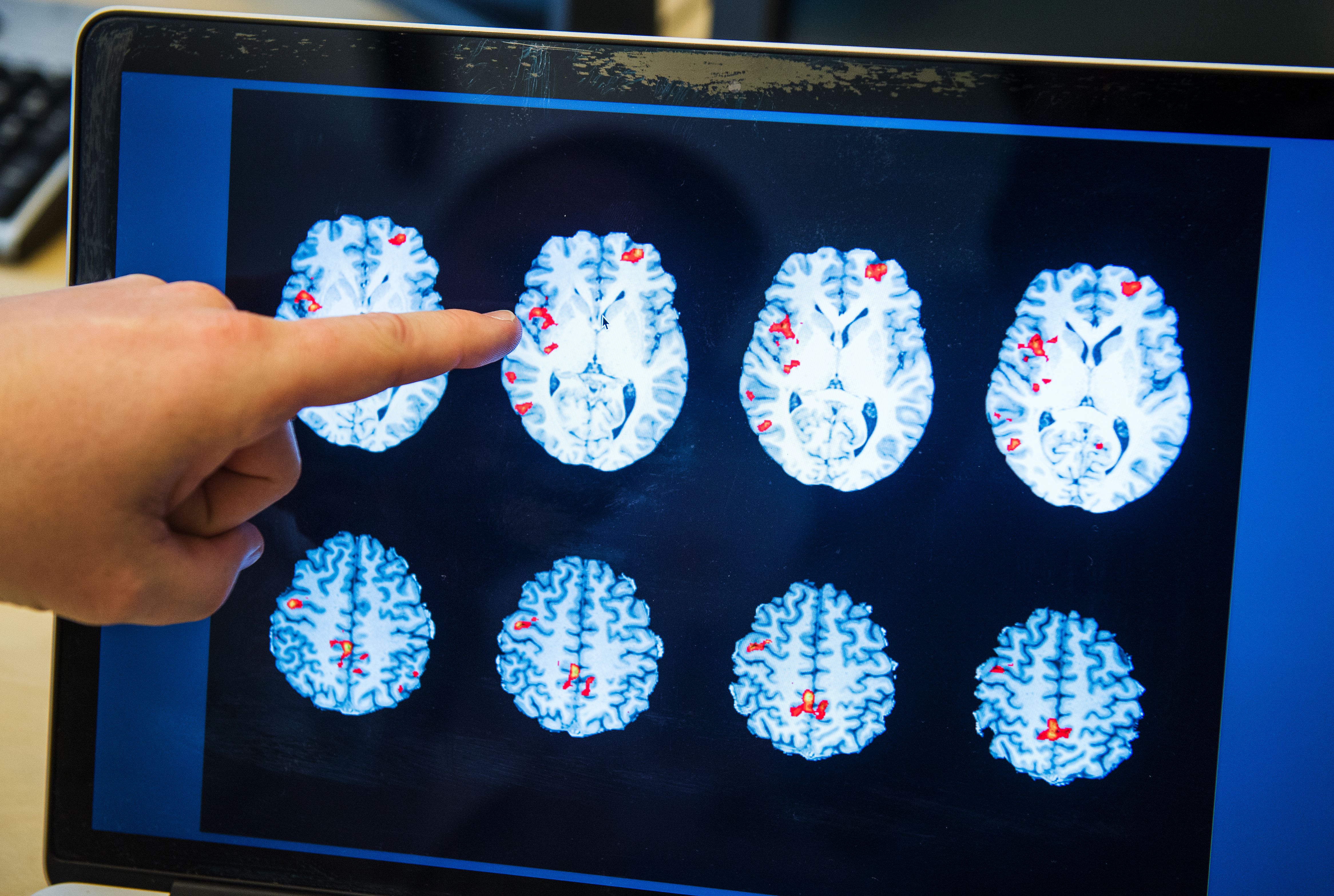 El Parkinson ataca a las neuronas que producen dopamina, un químico cerebral