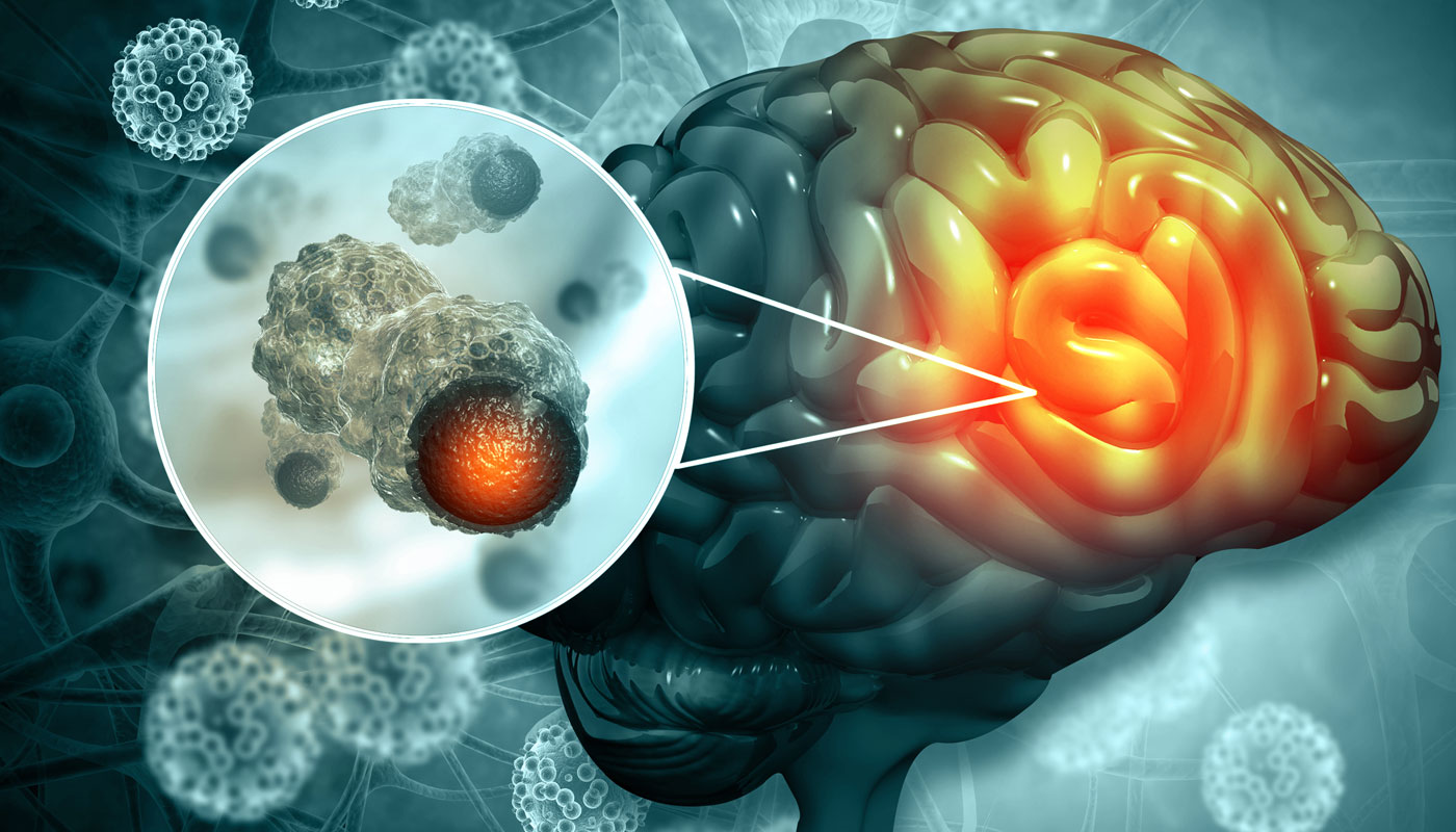 Tumor no cérebro
